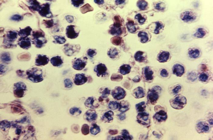 Microscopic View of Meningitis